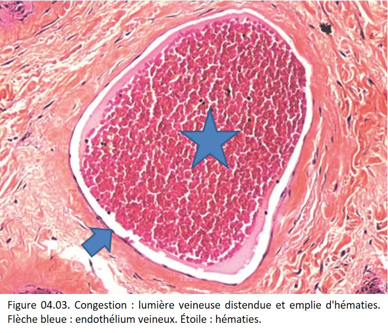 Société Française de Pathologie - 4. Pathologie vasculaire et ...