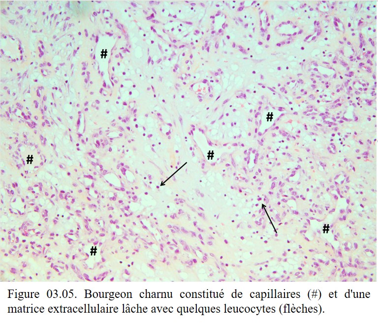 Société Française de Pathologie - 3. Réaction inflammatoire ...