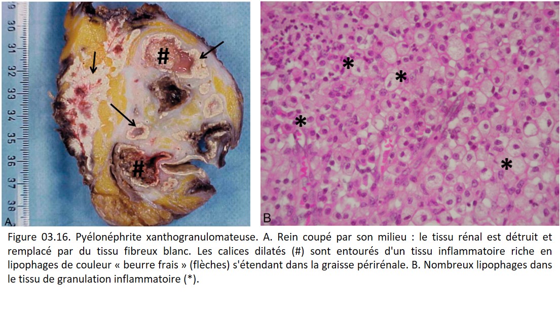 Société Française de Pathologie - 3. Réaction inflammatoire ...