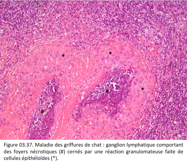 Société Française de Pathologie - 3. Réaction inflammatoire ...