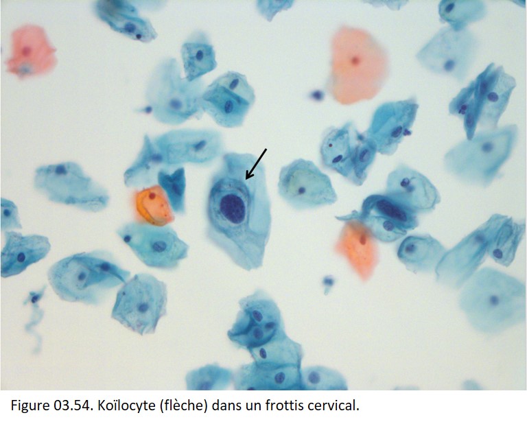 Société Française de Pathologie - 3. Réaction inflammatoire ...