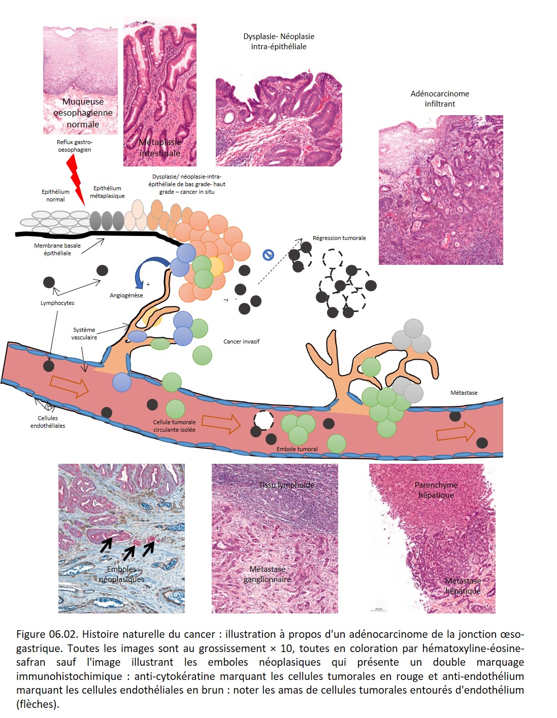 Société Française de Pathologie - 6. Histoire naturelle du cancer