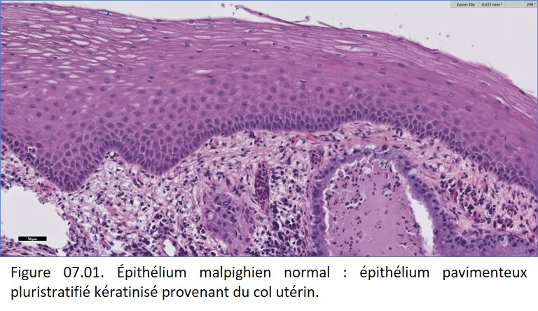 Société Française de Pathologie - 7. Tumeurs épithéliales