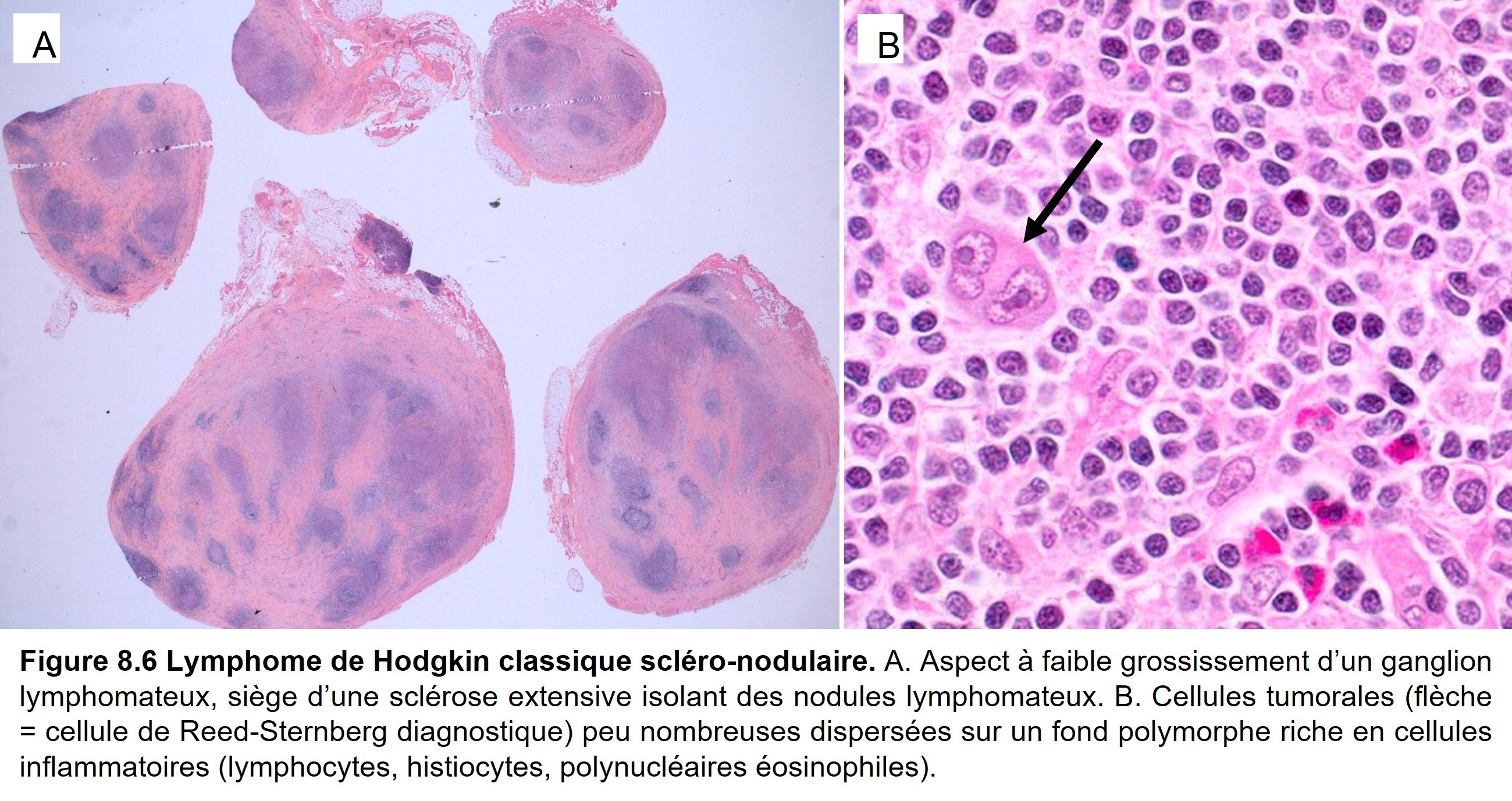 Société Française de Pathologie - 8. Tumeurs non épithéliales