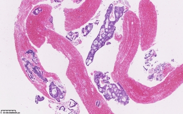 cytoponction sous échoendoscopie tumeur du pancréas