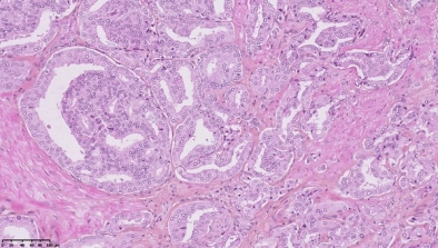 cancer prostate