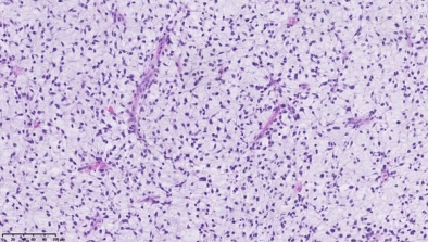 liposarcome myxoide