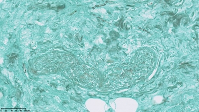 mucormycose digestive coloration grocott