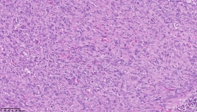 angiosarcome